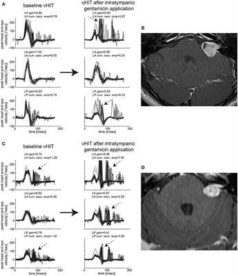 Pre-habilitation Before Vestibular Schwannoma Surgery—Impact of Intratympanal Gentamicin Application on the Vestibulo-Ocular Reflex